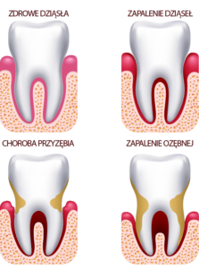Periodontologia-przykłady-schorzeń